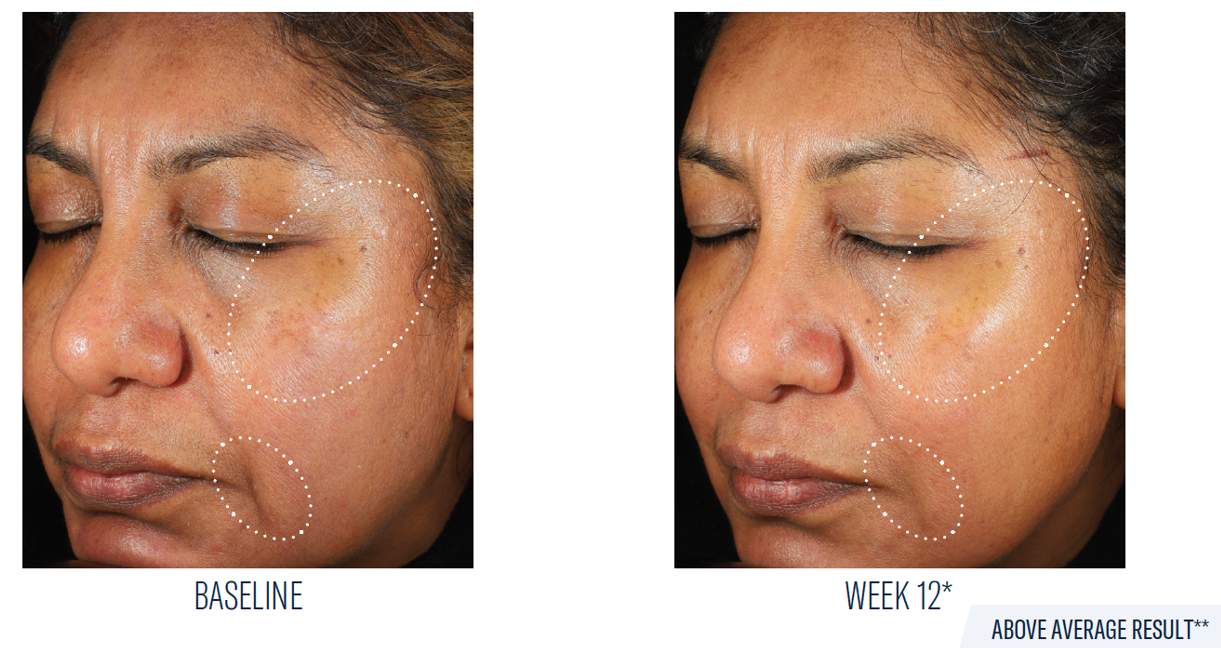 SkinBetter Science Mystro Revive Renewing Serum