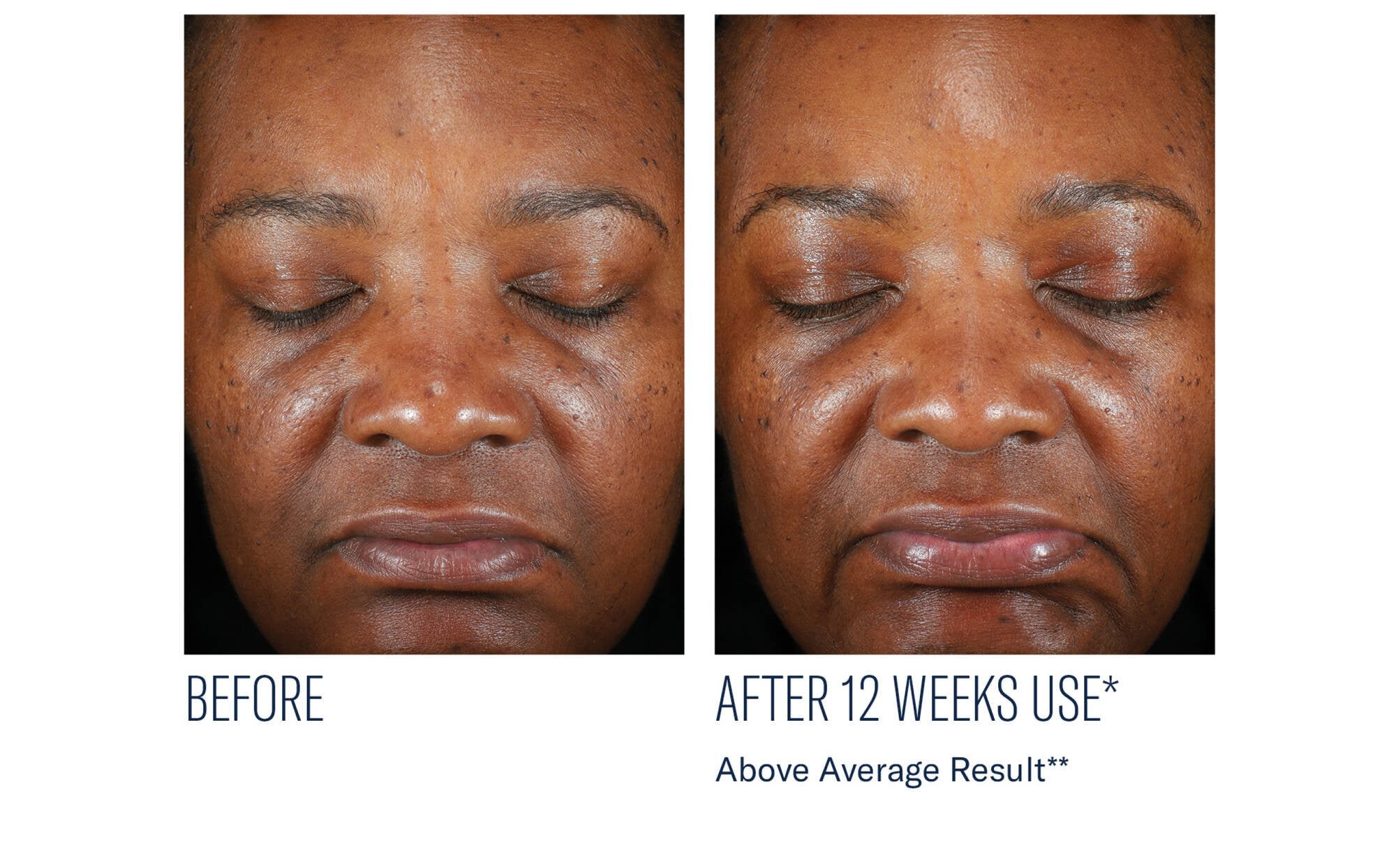 SkinBetter Science Even Intensive Skin Tone Correcting Serum