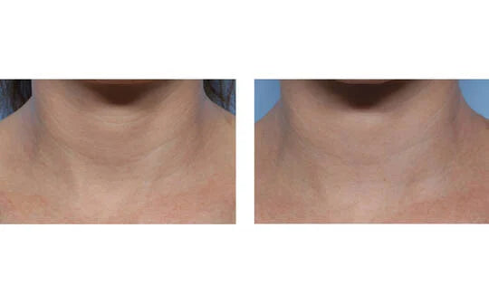 SkinBetter Science Techno Neck Perfecting Cream