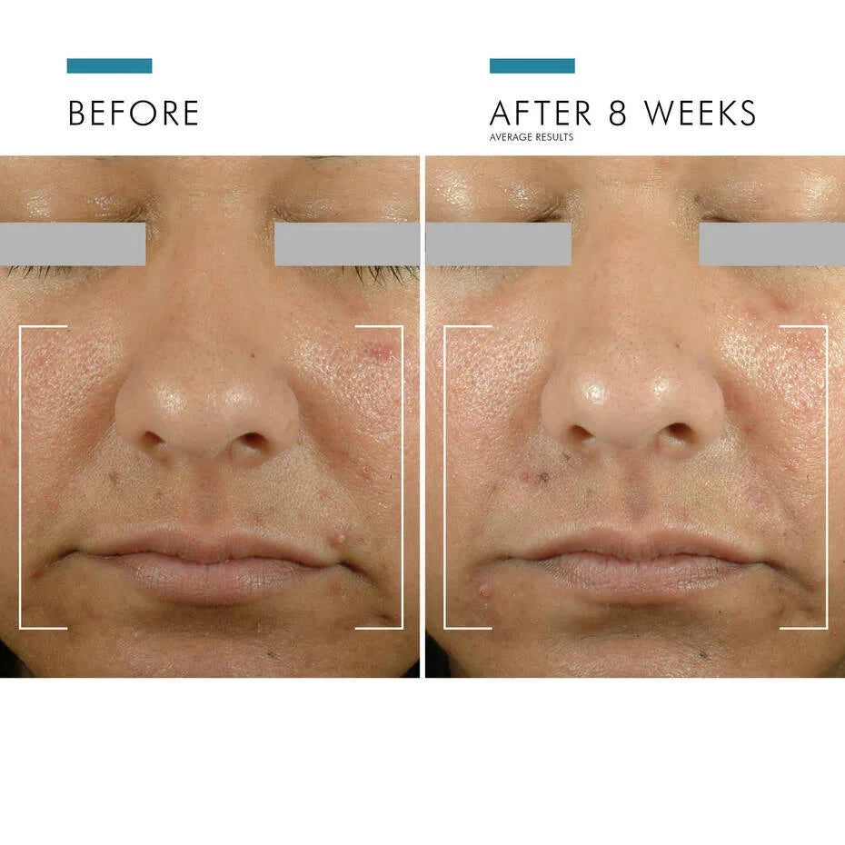 SkinCeuticals Blemish + Age Defense