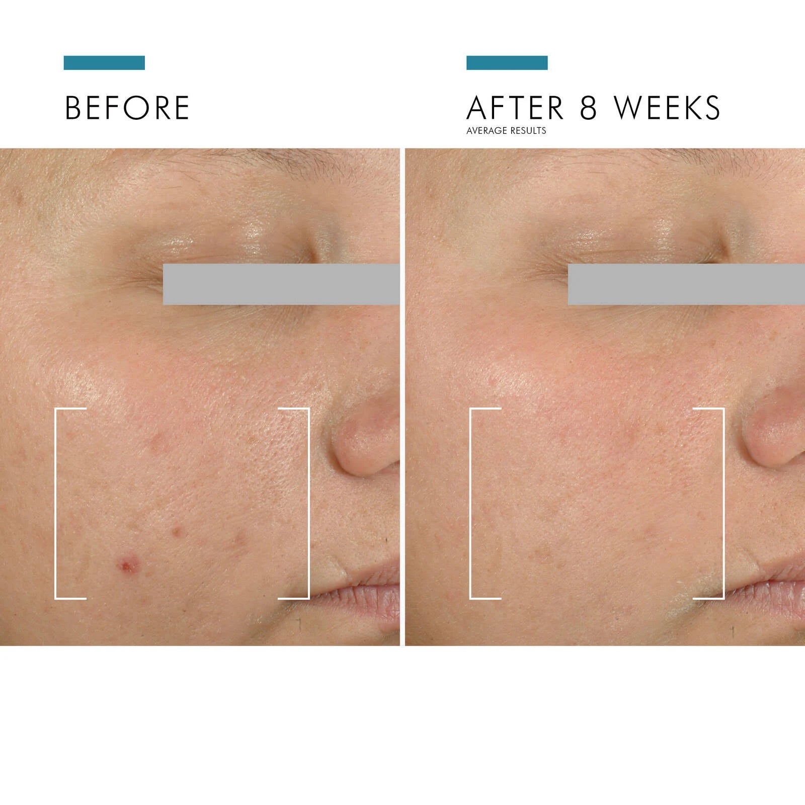 SkinCeuticals Blemish + Age Defense